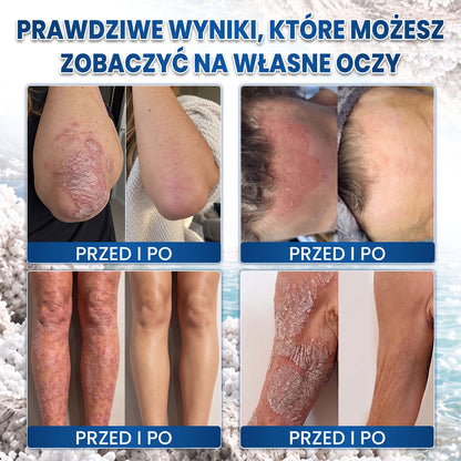 Medistart® Specjalistyczna Pielęgnacja Skóry z Łuszczycą
